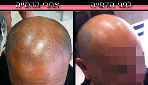 לפני ואחרי טיפול הדמיית שיער - אבי משיח