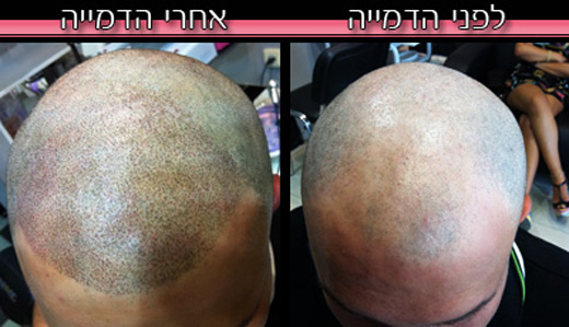 לפני ואחרי טיפול הדמיית שיער - אבי משיח
