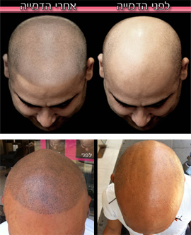 לפני ואחרי טיפול הדמיית שיער - אבי משיח