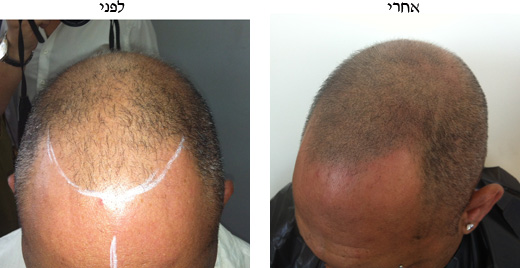 לפני ואחרי של הדמיית שיער שעשה מעצב השיער יוסי אמיר