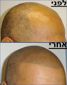 מיקרופיגמנטציה (הדמיית זקיקי שיער) ואין לך קרחת. תמונה באדיבות עדי שנדל