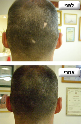 הדמיית שיער לגברים בתל אביב - מיטל שמשי