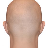 התקרחות ואמונות טפלות
