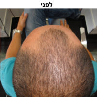 לפני ואחרי הדמיית זקיקי שיער בהרצליה